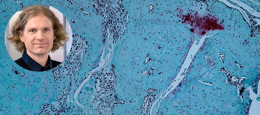 Mattias Svensson, forskare på avdelningen för reumatologi och inflammationsforskning vid Göteborgs universitet Mattias Svensson, forskare på avdelningen för reumatologi och inflammationsforskning vid Göteborgs universitet